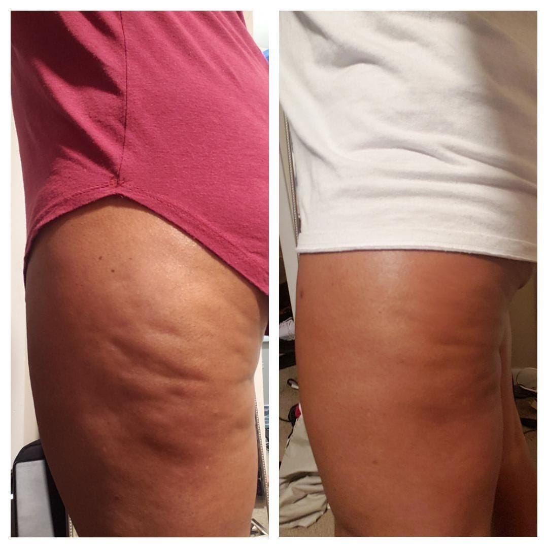 Anti-Cellulite Massage Oil